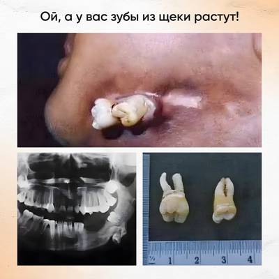 Эктопический моляр: прорезывание через кожу.